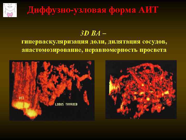 Диффузно-узловая форма АИТ 3 D ВА – гиперваскуляризация доли, дилятация сосудов, анастомозирование, неравномерность просвета