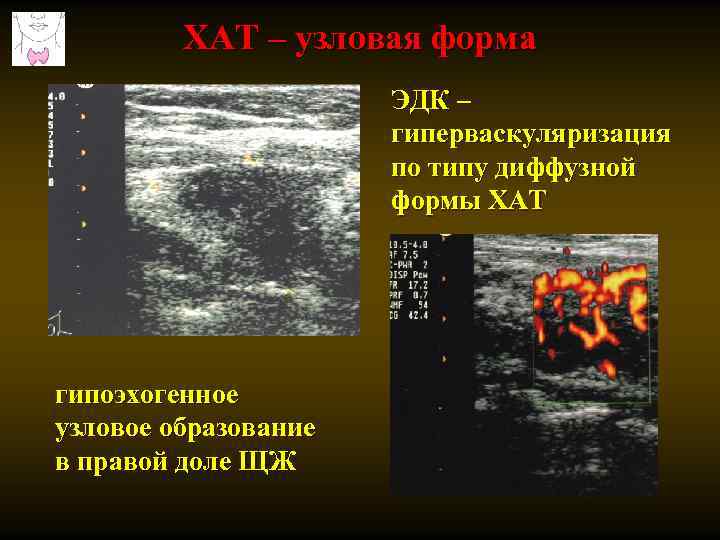 ХАТ – узловая форма ЭДК – гиперваскуляризация по типу диффузной формы ХАТ гипоэхогенное узловое