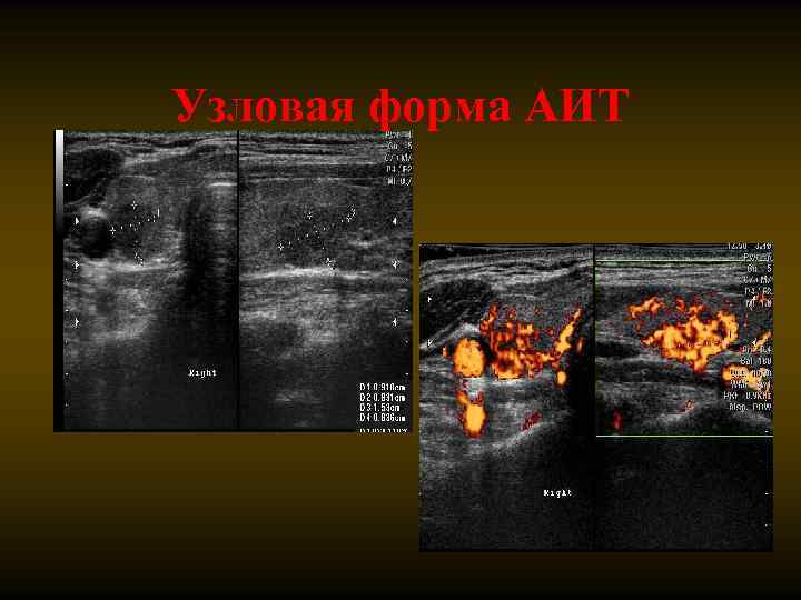 Узловая форма АИТ 