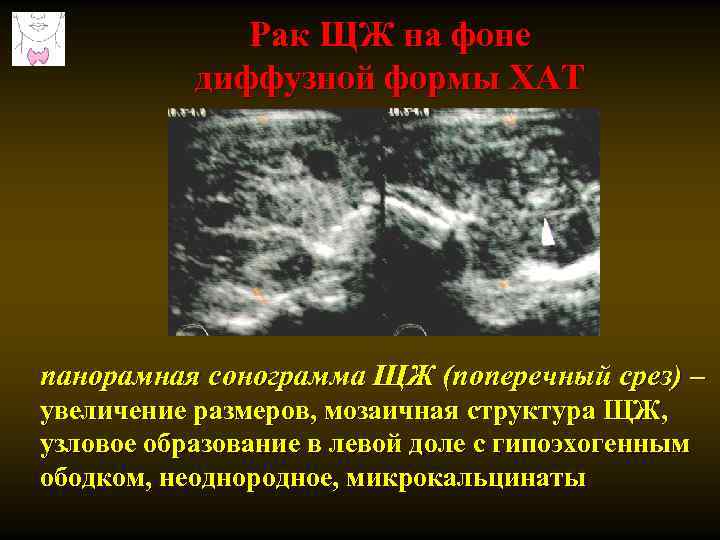 Рак ЩЖ на фоне диффузной формы ХАТ панорамная сонограмма ЩЖ (поперечный срез) – увеличение