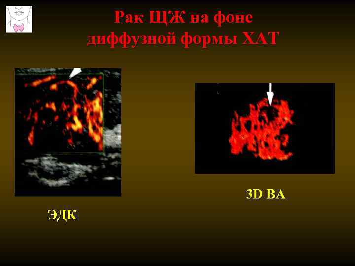 Рак ЩЖ на фоне диффузной формы ХАТ 3 D ВА ЭДК 
