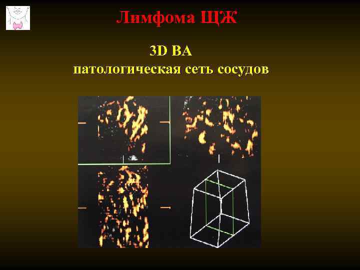 Лимфома ЩЖ 3 D ВА патологическая сеть сосудов 