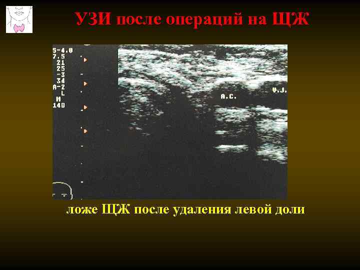 УЗИ после операций на ЩЖ ложе ЩЖ после удаления левой доли 