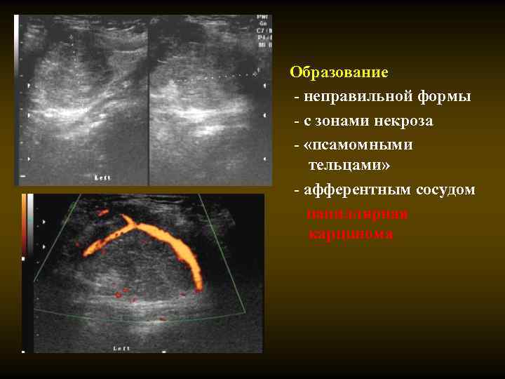 Образование - неправильной формы - с зонами некроза - «псамомными тельцами» - афферентным сосудом