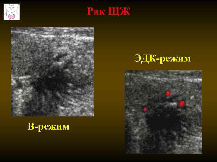 Рак ЩЖ ЭДК-режим В-режим 