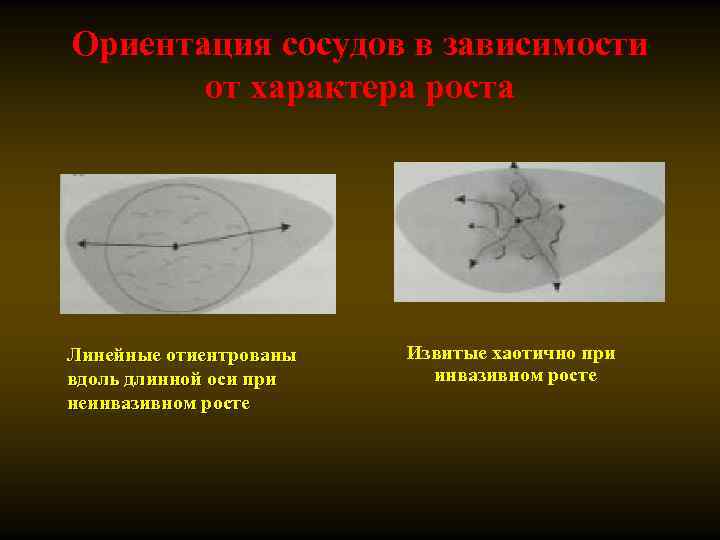 Ориентация сосудов в зависимости от характера роста Линейные отиентрованы вдоль длинной оси при неинвазивном
