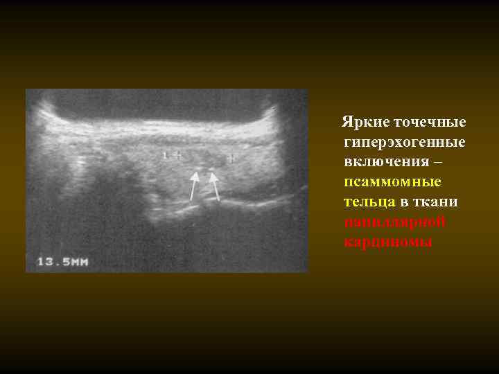 Яркие точечные гиперэхогенные включения – псаммомные тельца в ткани папиллярной карциномы 