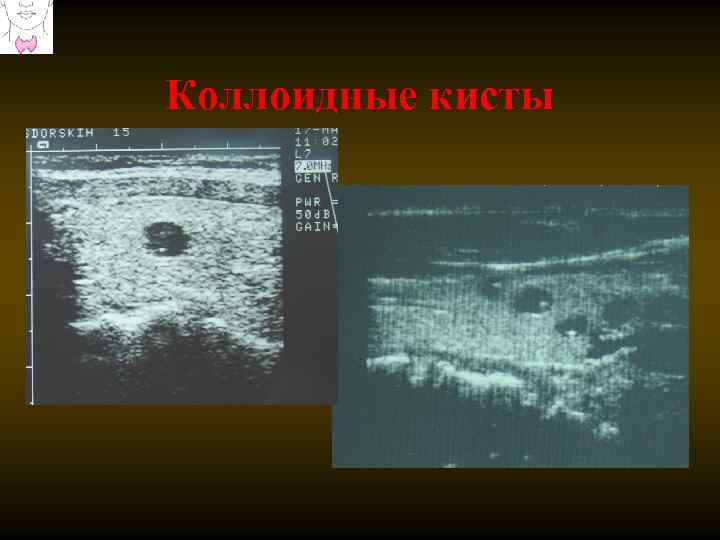 Коллоидные кисты 