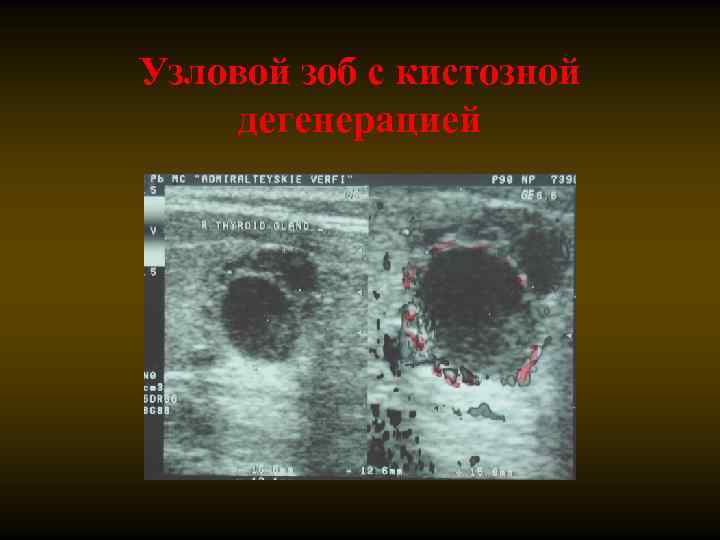 Узловой зоб с кистозной дегенерацией 