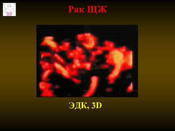 Рак ЩЖ ЭДК, 3 D 