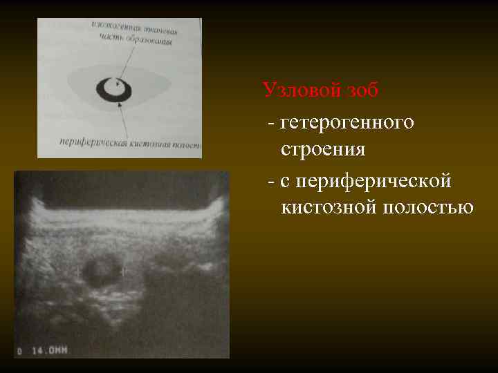 Узловой зоб - гетерогенного строения - с периферической кистозной полостью 