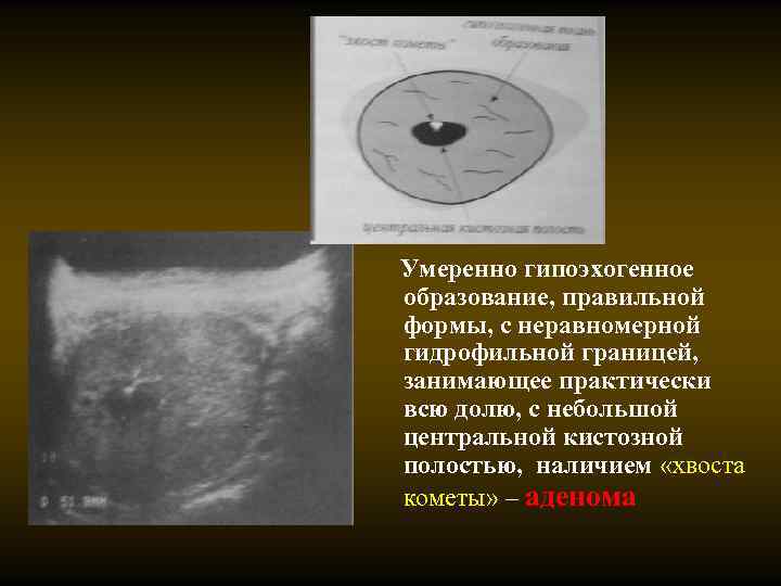 Умеренно гипоэхогенное образование, правильной формы, с неравномерной гидрофильной границей, занимающее практически всю долю, с
