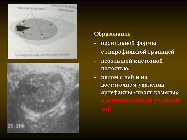 Образование - правильной формы - с гидрофильной границей - небольшой кистозной полостью, - рядом