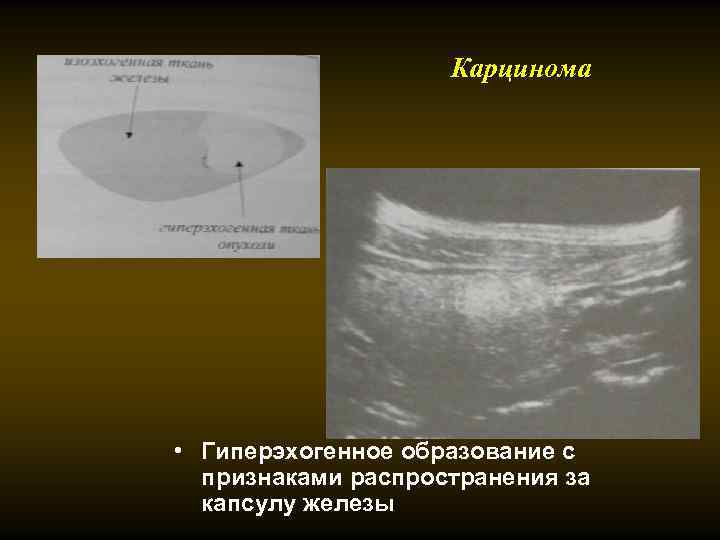 Карцинома • Гиперэхогенное образование с признаками распространения за капсулу железы 