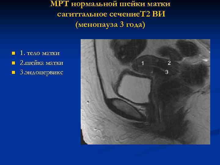 МРТ нормальной шейки матки сагиттальное сечение. Т 2 ВИ (менопауза 3 года) n n