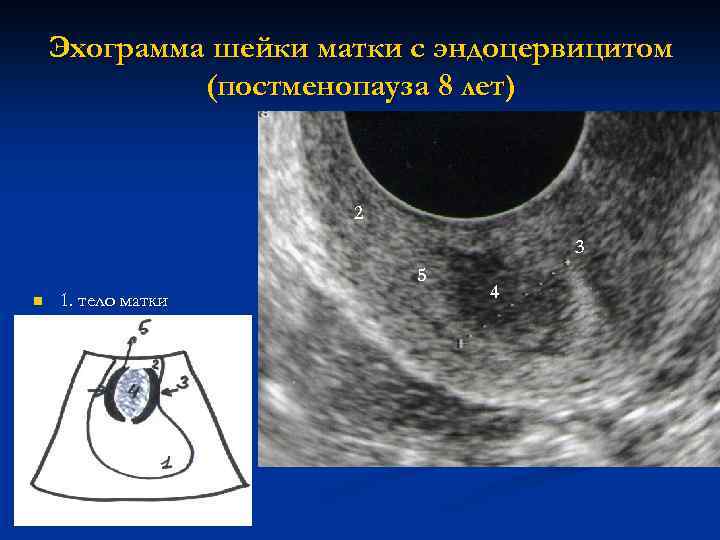 Эхограмма шейки матки с эндоцервицитом (постменопауза 8 лет) 2 3 5 n n n