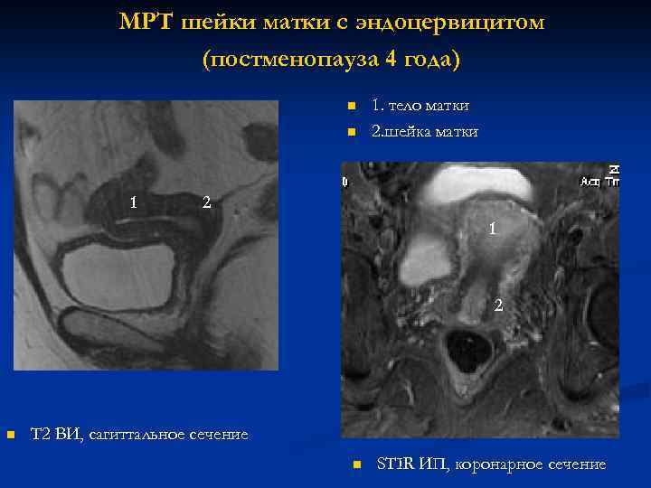 МРТ шейки матки с эндоцервицитом (постменопауза 4 года) n n 1. тело матки 2.