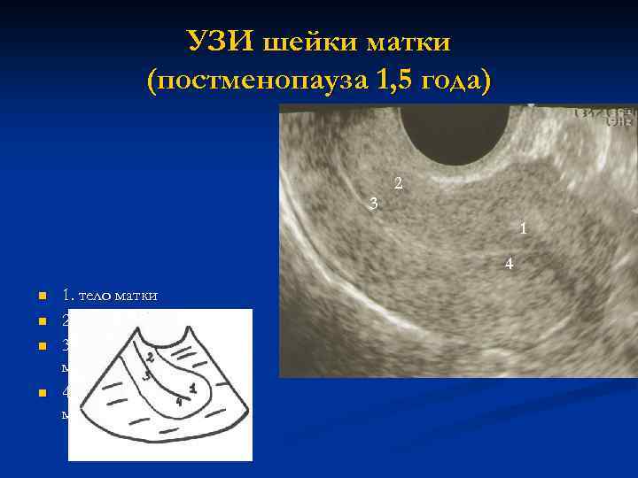 УЗИ шейки матки (постменопауза 1, 5 года) 4 2 3 1 3 n n