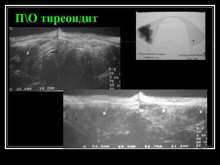 ПО тиреоидит 