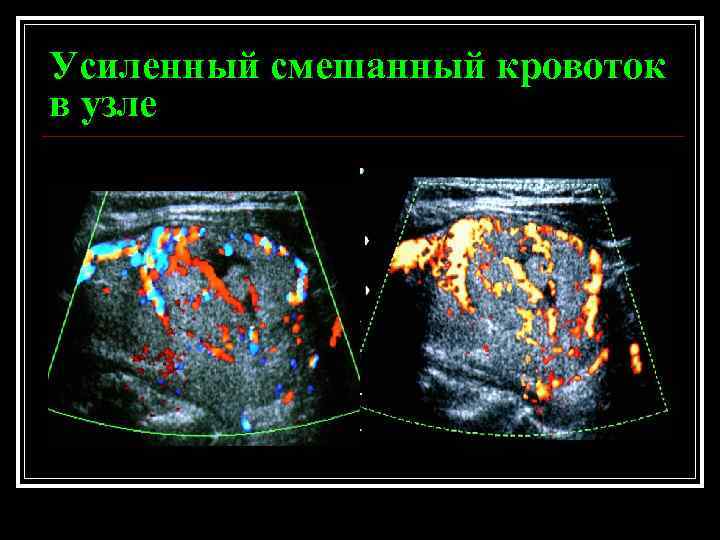 Усиленный смешанный кровоток в узле 