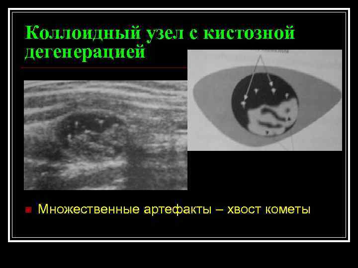 Коллоидный узел с кистозной дегенерацией n Множественные артефакты – хвост кометы 