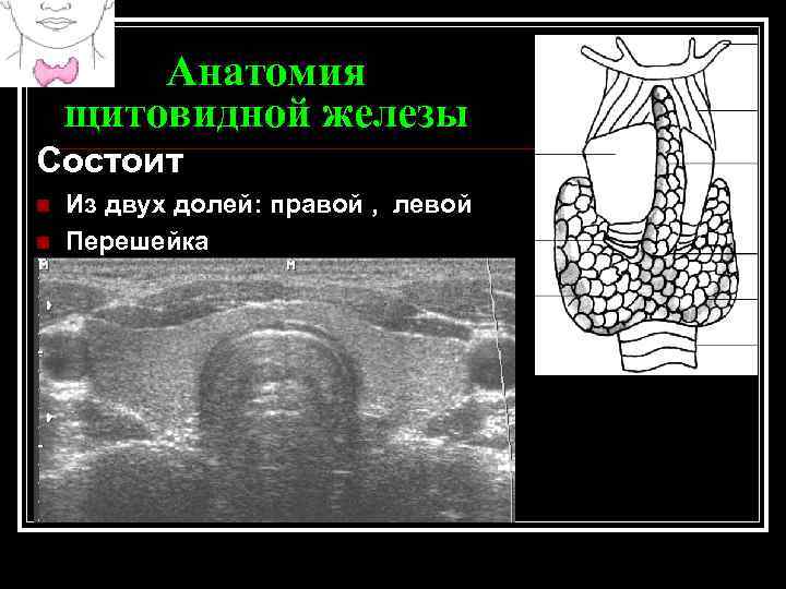Аплазия щитовидной железы. Сегменты щитовидной железы на УЗИ. Сегменты перешейка щитовидной железы. Аплазия доли щитовидной железы УЗИ. Аплазии левой доли щитовидной.