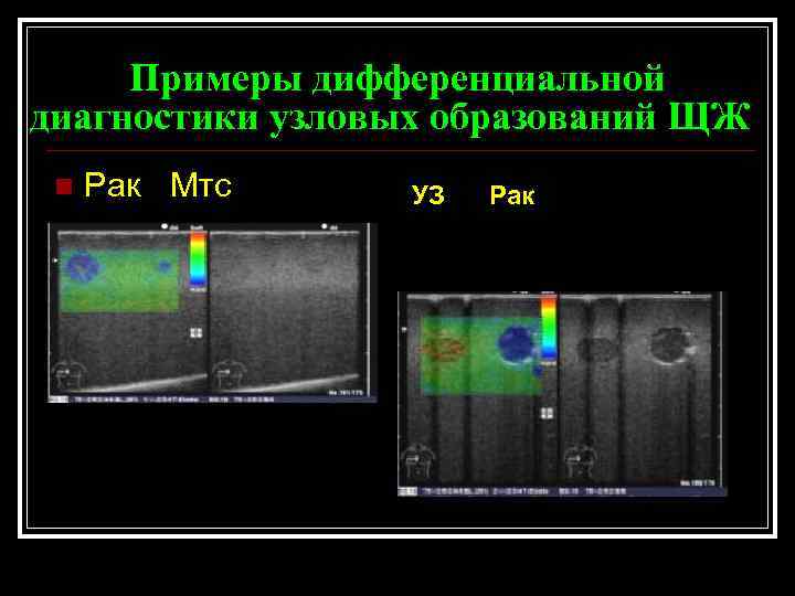 Примеры дифференциальной диагностики узловых образований ЩЖ n Рак Мтс УЗ Рак 