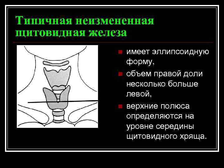 Типичная неизмененная щитовидная железа n n n имеет эллипсоидную форму, объем правой доли несколько