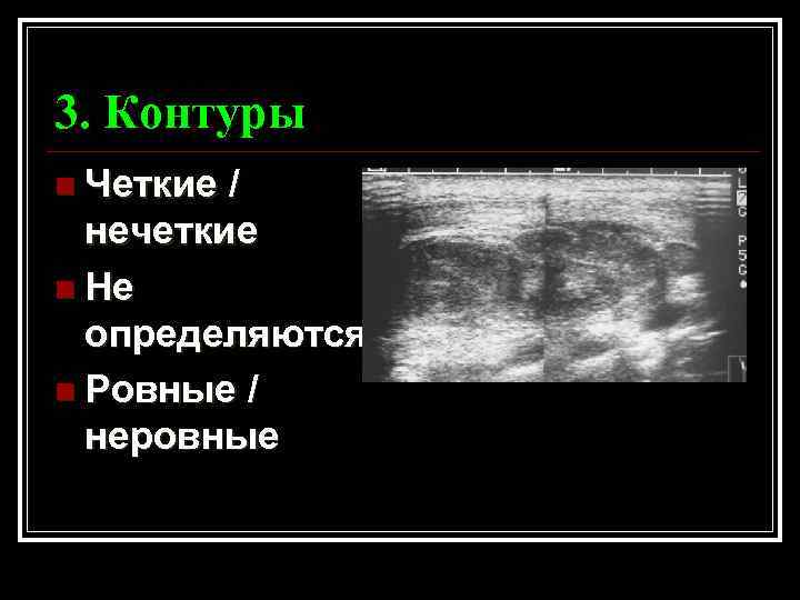 3. Контуры n Четкие / нечеткие n Не определяются n Ровные / неровные 