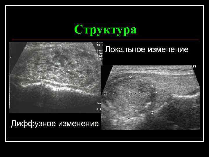 Структура Локальное изменение Диффузное изменение 