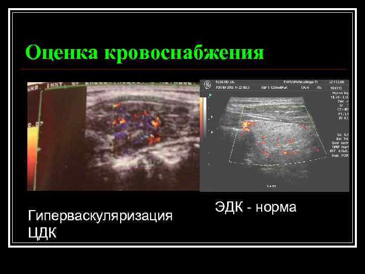 В режиме цдк сосудистый рисунок усилен