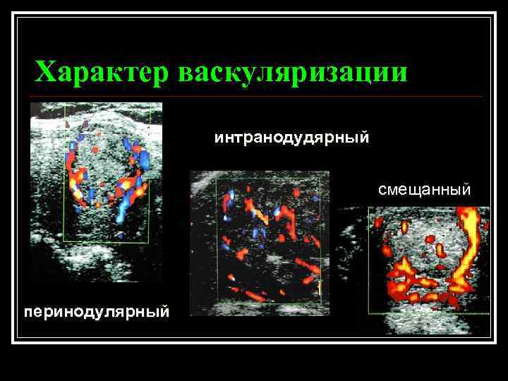 Характер васкуляризации интранодудярный смещанный перинодулярный 