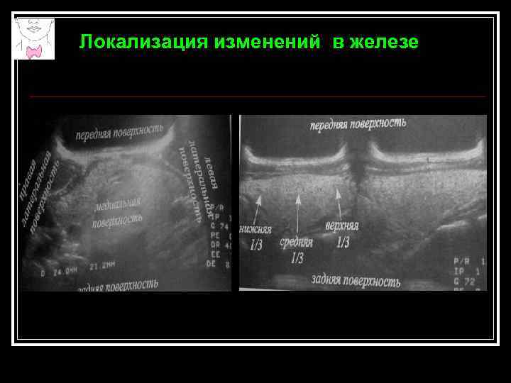 Локализация изменений в железе 