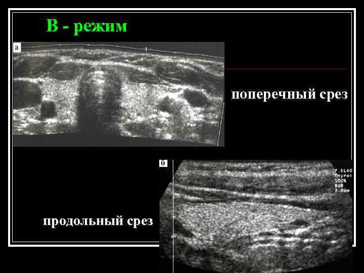 В - режим поперечный срез продольный срез 