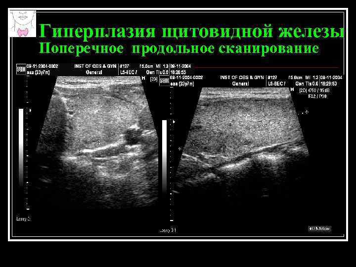 Гиперплазия желез. Гиперплазия щитовидной железы УЗИ. Узловая гиперплазия щитовидной железы на УЗИ. Гиперплазия доли щитовидной железы на УЗИ. УЗИ поперечное сканирование щитовидной железы.