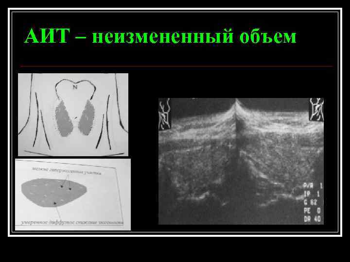 АИТ – неизмененный объем 