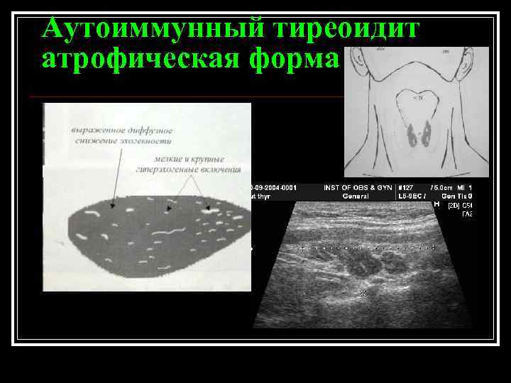 Щитовидная железа аит узи. АИТ на УЗИ щитовидной железы. Хронический аутоиммунный тиреоидит щитовидной железы УЗИ. Тиреоидит Хашимото УЗИ. АИТ гипертрофическая форма УЗИ.