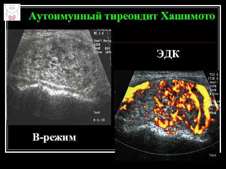 Щитовидная железа аит узи. Хронический аутоиммунный тиреоидит УЗИ. Аутоиммунный тиреоидит Хашимото на УЗИ. Исход тиреоидита Хашимото.