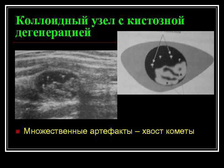 Коллоидный узел щитовидной железы. Коллоидный узел щитовидной. Кистозная дегенерация узла щитовидной железы. Коллоидный узел с кистозной дегенерацией. Узелково кистозная дегенерация.