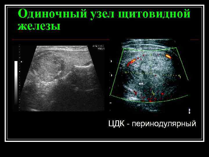 Узлы щитовидной железы отзывы пациентов. Одиночный узел в щитовидной железе. Солидный узел щитовидной железы. Узел щитовидной железы ЦДК. Узел в щитовидной железе 4 мм.