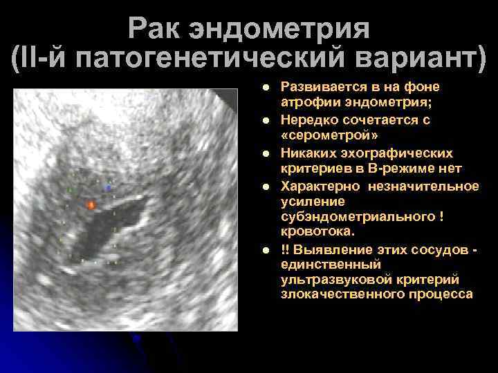 Рак эндометрия (II-й патогенетический вариант) l l l Развивается в на фоне атрофии эндометрия;