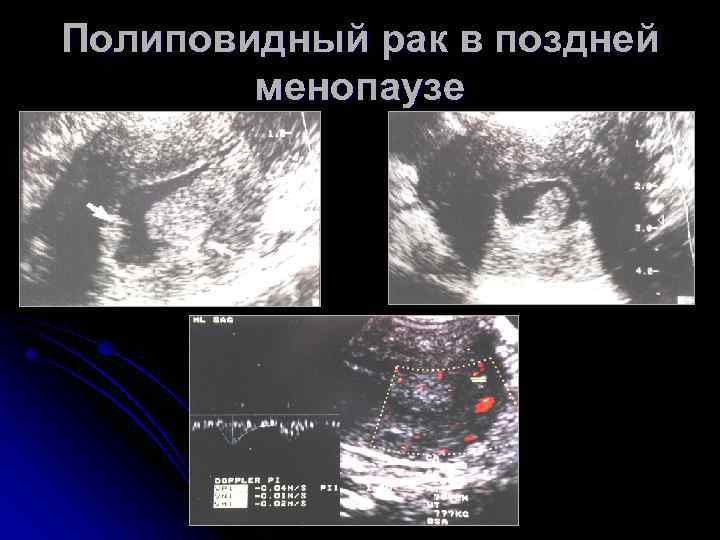 Полиповидный рак в поздней менопаузе 