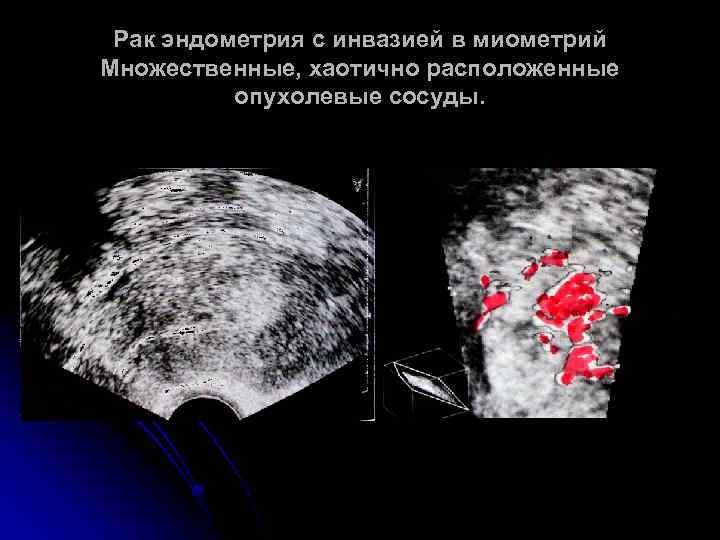 Рак эндометрия с инвазией в миометрий Множественные, хаотично расположенные опухолевые сосуды. 