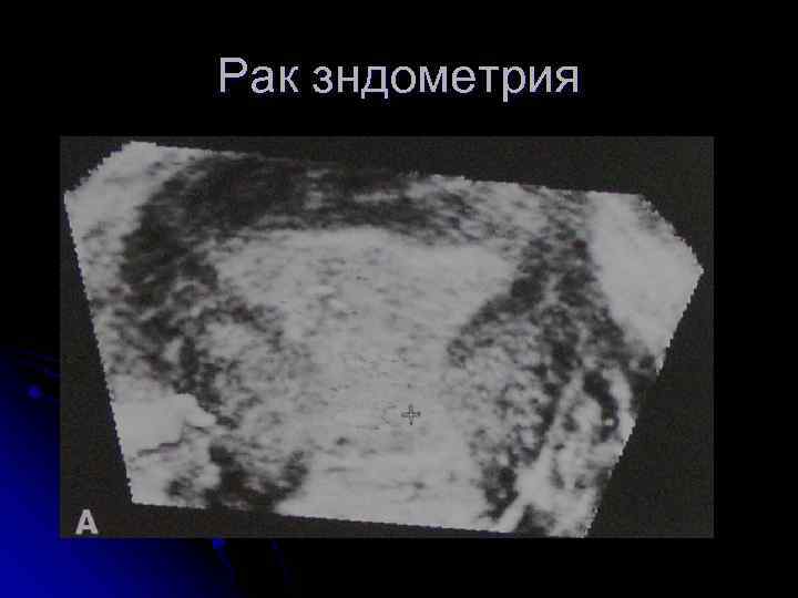 Рак зндометрия 