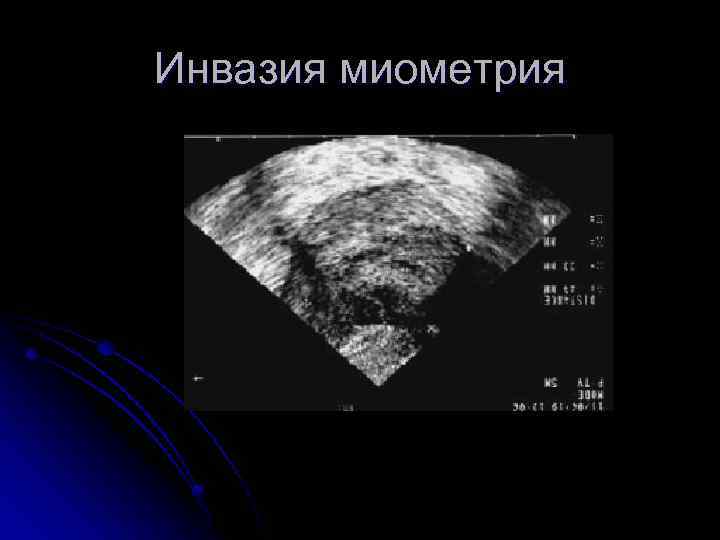 Инвазия миометрия 