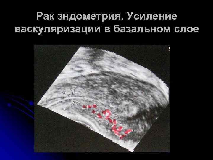 Рак зндометрия. Усиление васкуляризации в базальном слое 