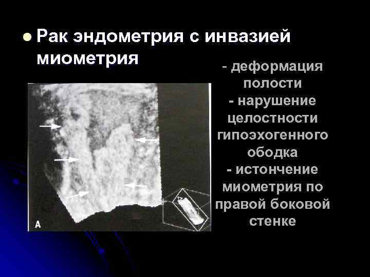 l Рак эндометрия с инвазией миометрия - деформация полости - нарушение целостности гипоэхогенного ободка
