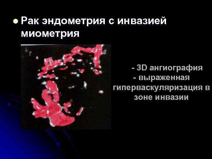 l Рак эндометрия с инвазией миометрия - 3 D ангиография - выраженная гиперваскуляризация в