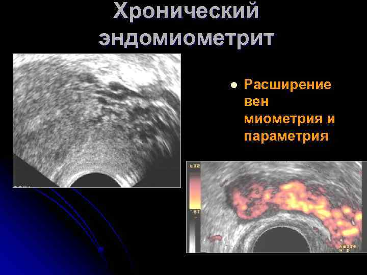 Хронический эндомиометрит l Расширение вен миометрия и параметрия 