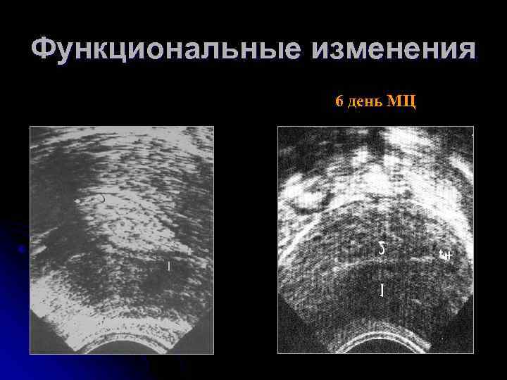 Функциональные изменения 6 день МЦ 